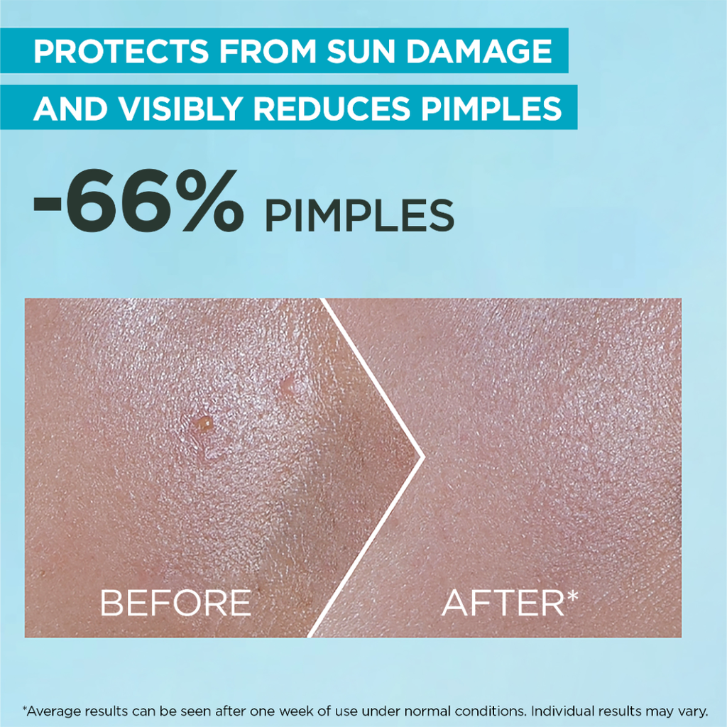 BEFOREANDAFTEROFGarnierFastClearGentleCleanserHydratingFaceWashforAcneProneSkin250ml.png